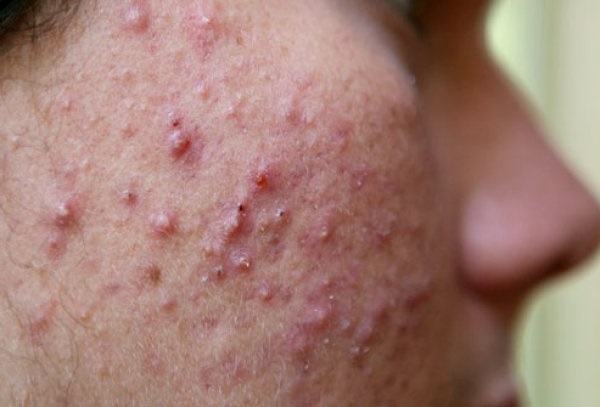 akne trudovitost uhry bylinky byliny babske rady obklady bylinne caje