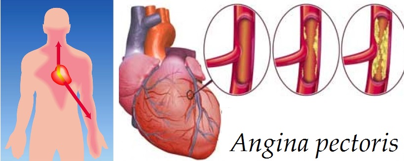 angina pectoris zuzene koronarni tepny srdce byliny bylinky babske rady caj obklad