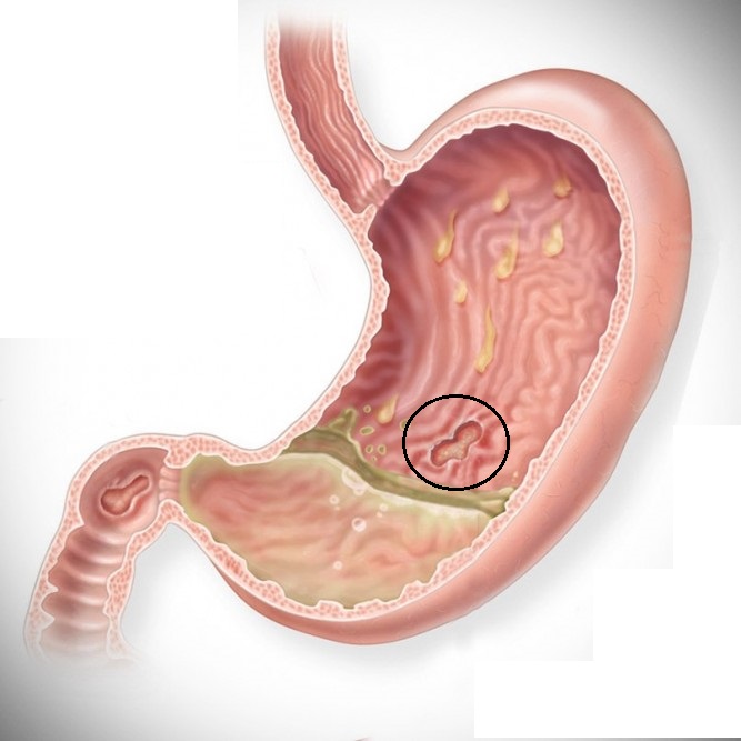 dvanacternik zaludecni vredy byliny bylinky babske rady lecba bez leku