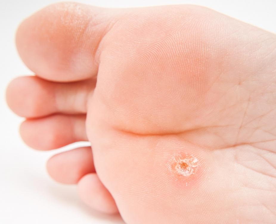 kuri oko byliny bylinky babske rady obklady