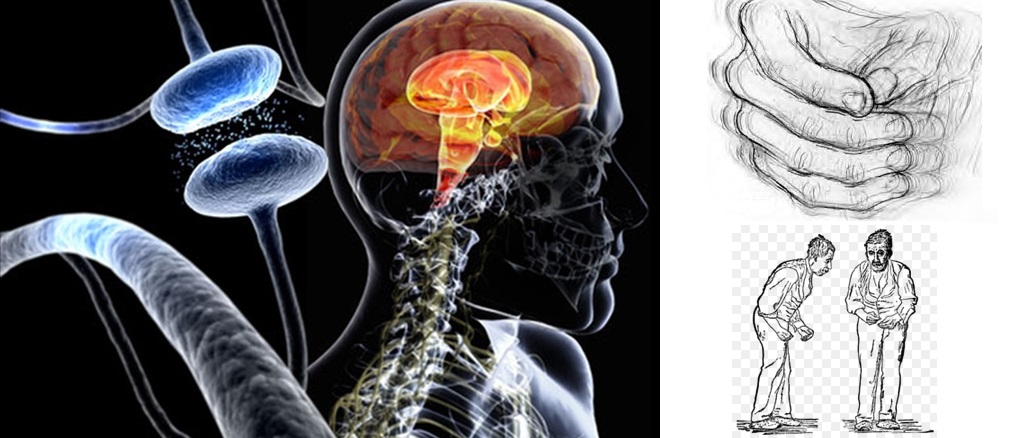 Parkinsonova choroba, nemoc - byliny, bylinky, babské rady, tinktury