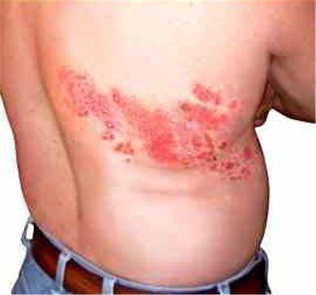 Pásový opar - byliny, bylinky, babské rady, mazání, obklad