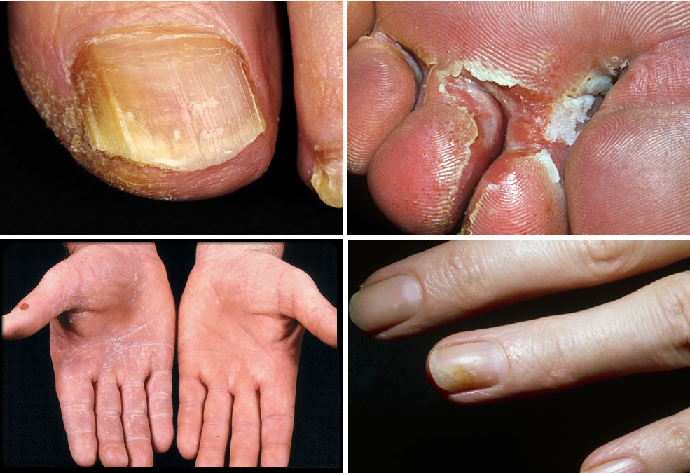 Plísně, plísňová onemocnění - byliny, bylinky, babské rady, mast, tinktura, obklad, čaj