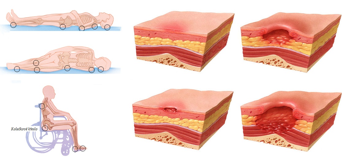 Proleženiny - byliny, bylinky, babské rady, prevence, masáže