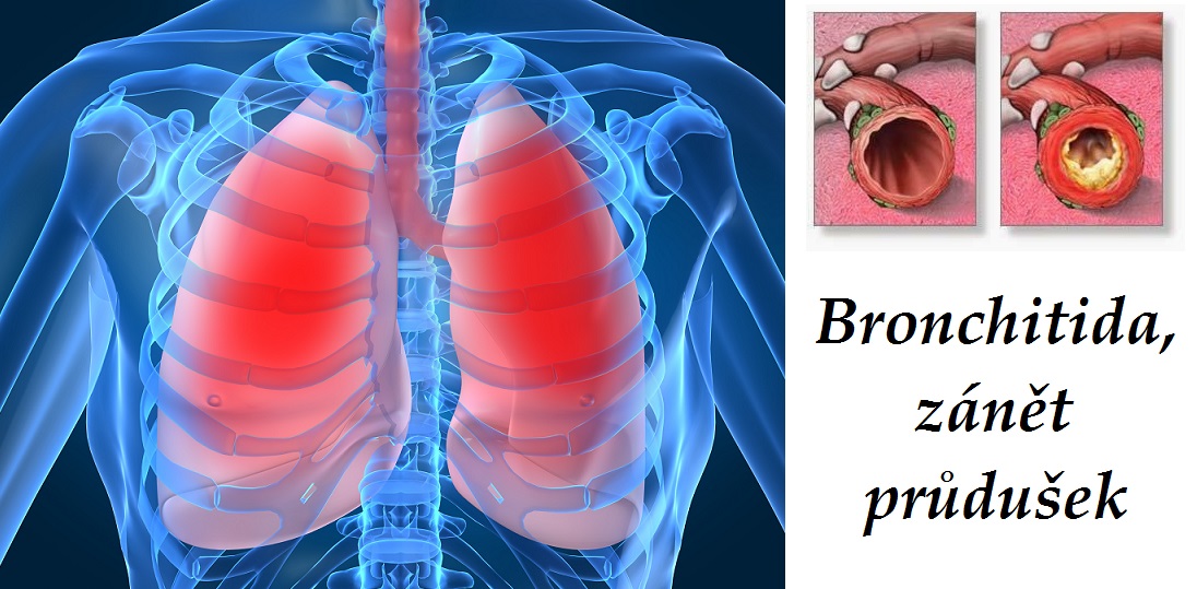 Zánět průdušek, bronchitida, zahlenění - byliny, bylinky, babské rady, čaje, obklady